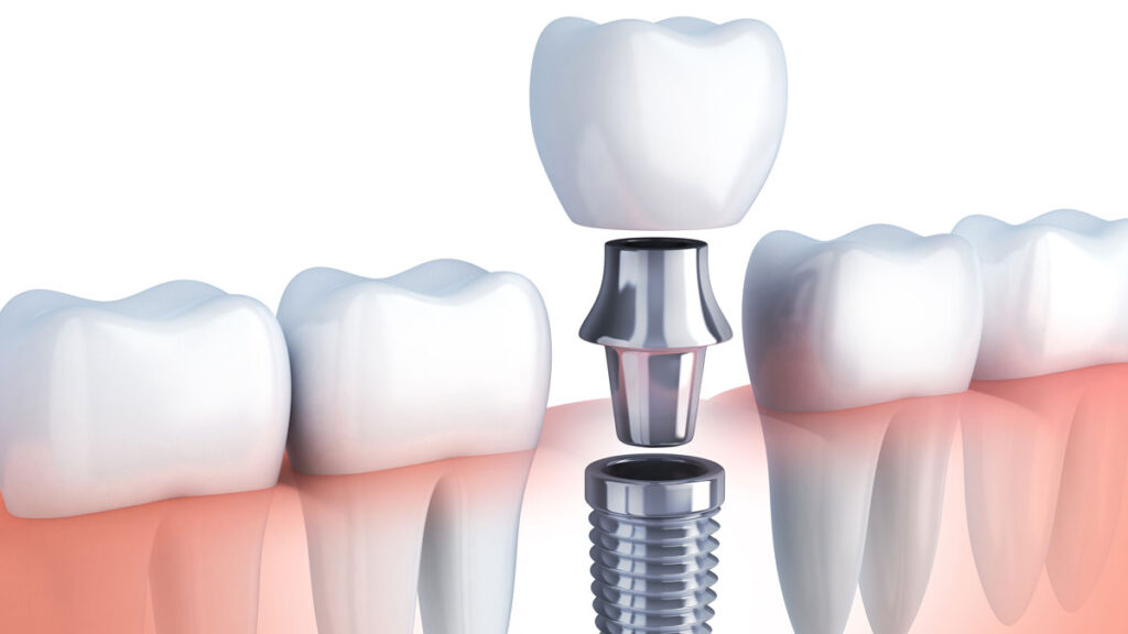 implant
